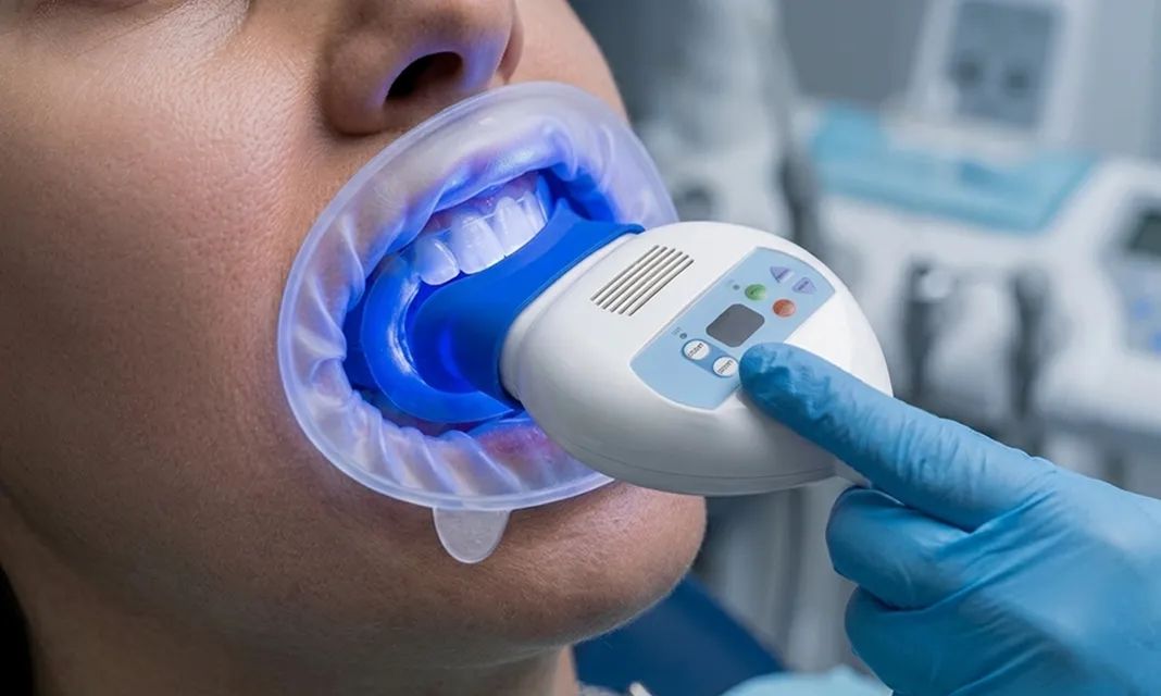 Blanqueamiento dental con lámpara de luz azul