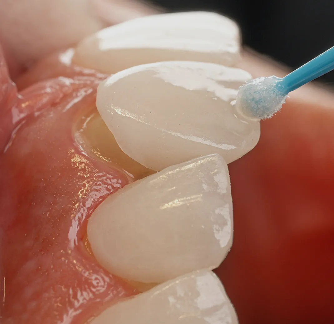 Aplicación de un gel sobre los dientes frontales con un microaplicador