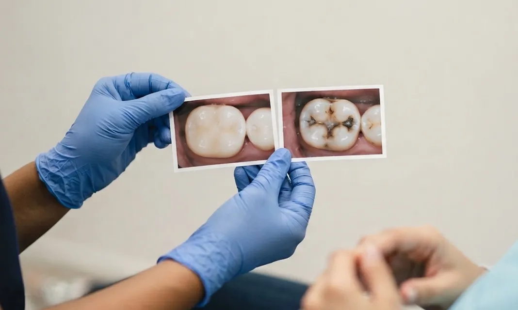 Radiografías de molares sostenidas con guantes