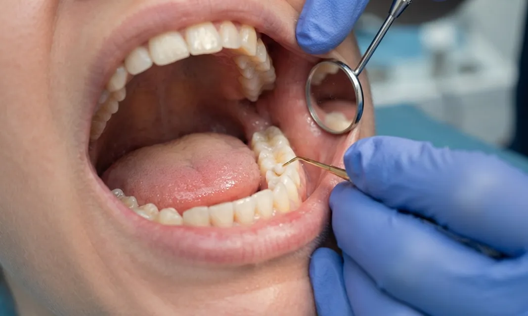 Revisión dental con espejo y explorador