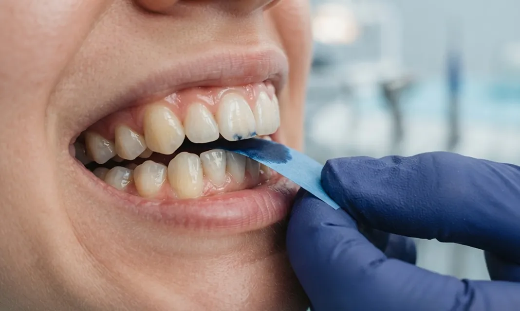 Aplicación de un instrumento sobre los dientes inferiores