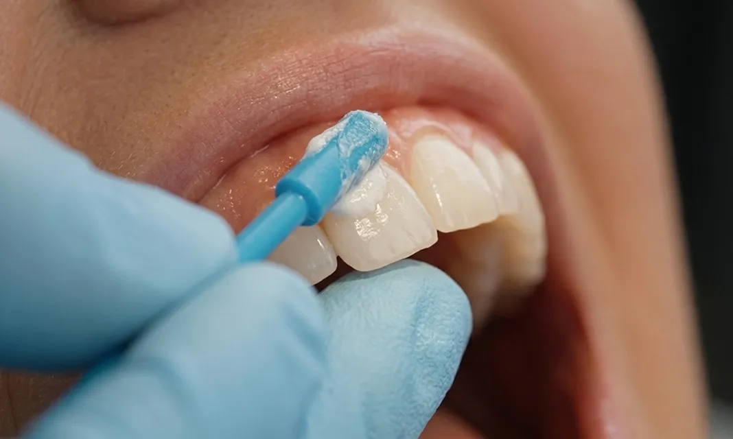 Aplicación de un gel preventivo sobre los dientes con un aplicador