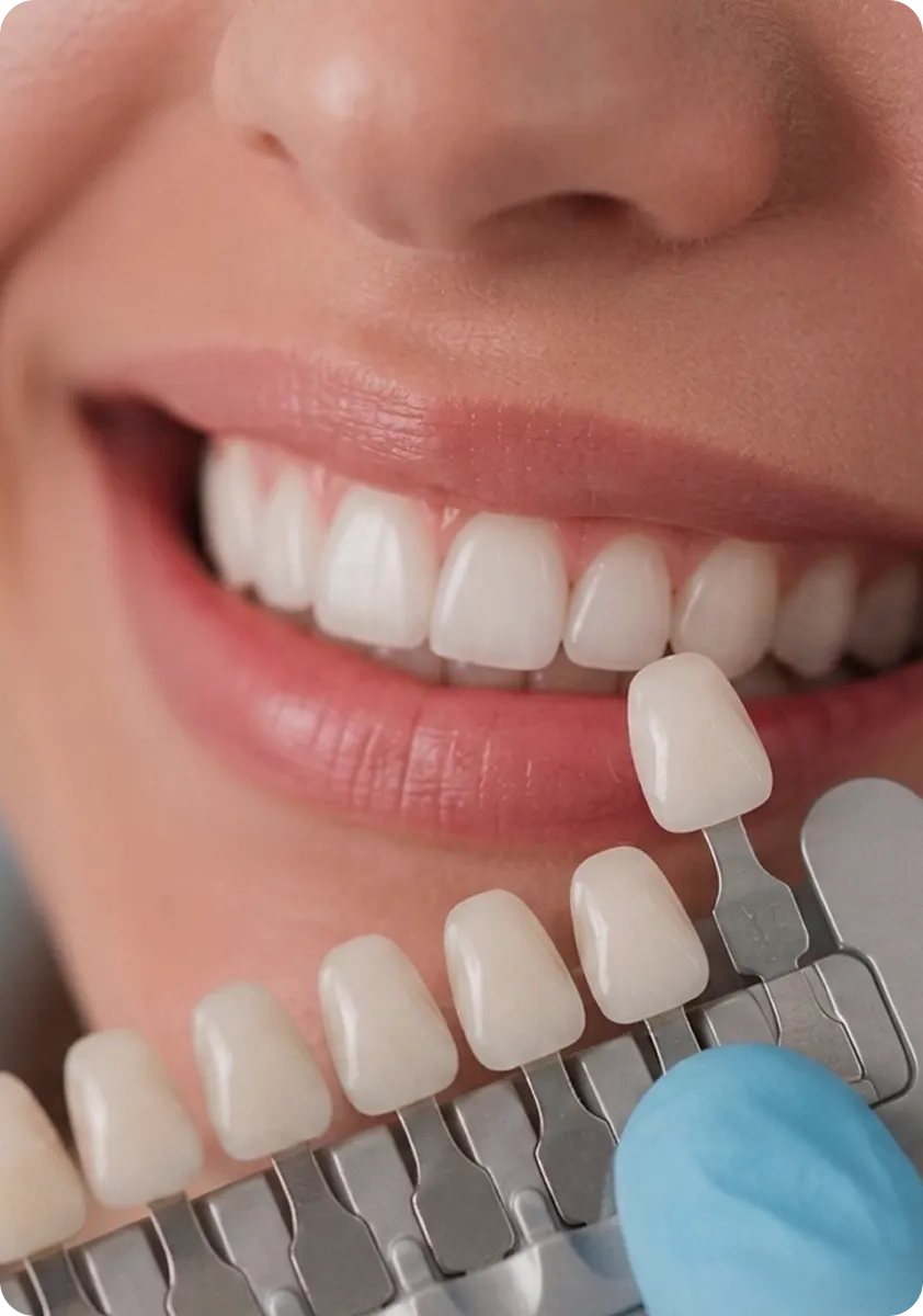 Guía de tonos dentales comparada con la sonrisa de una paciente